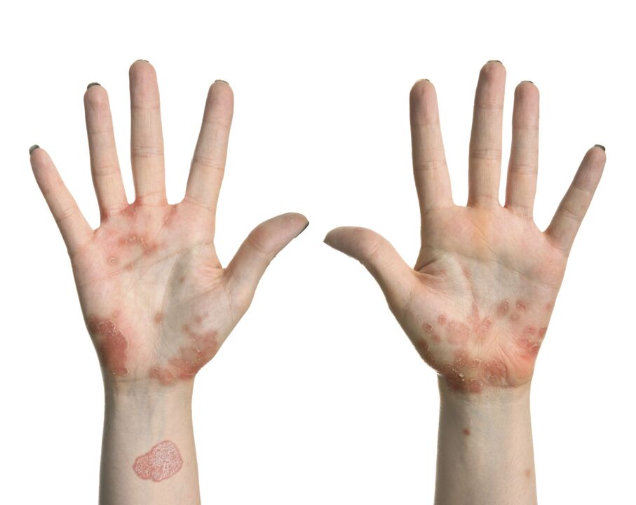 Psoriasis on hands